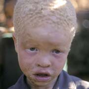 Albino boy